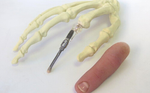 Implant Finger Prosthesis