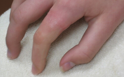 Prosthesis on Finger